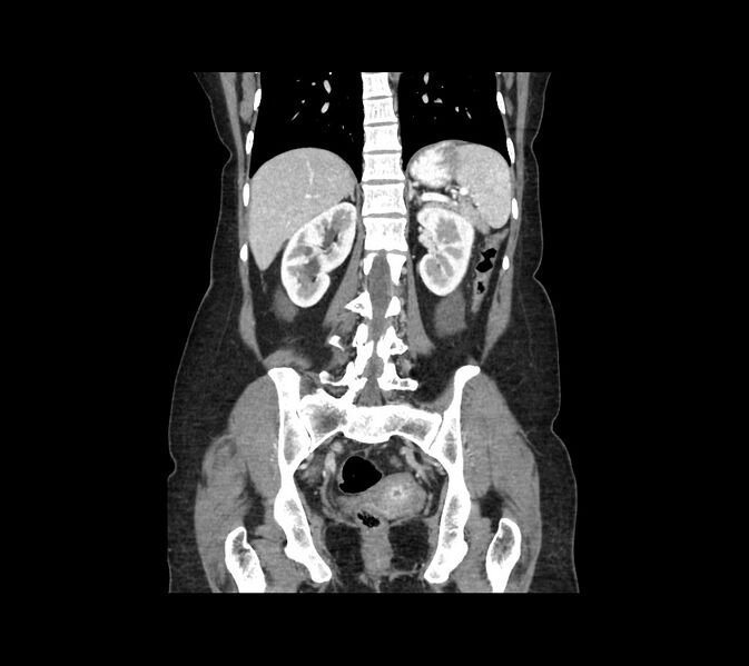 File:Cocoon abdomen with possible tubo-ovarian abscess (Radiopaedia 46235-50636 B 37).jpg