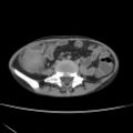 Colocolic fistula - Crohn disease (Radiopaedia 57063-63955 A 53).jpg