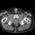 Colonic fistula (Radiopaedia 16047-15707 Axial non-contrast 69).jpg