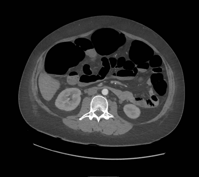 File:Colonic pseudo-obstruction (Radiopaedia 79752-92980 A 90).png