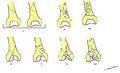 Distal femoral fractures- SOFCOT classification (Radiopaedia 39712).jpg
