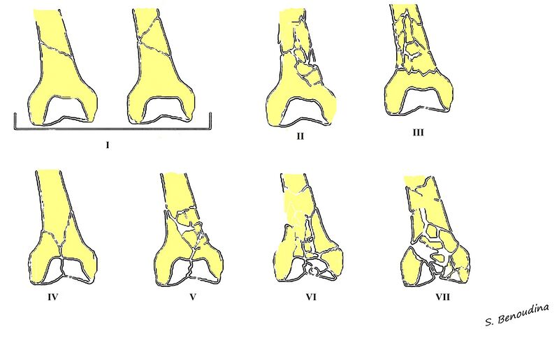 File:Distal femoral fractures- SOFCOT classification (Radiopaedia 39712).jpg
