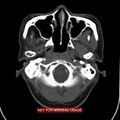 Nasopharyngeal carcinoma recurrence - skull base destruction (Radiopaedia 29107-29491 A 9).jpg