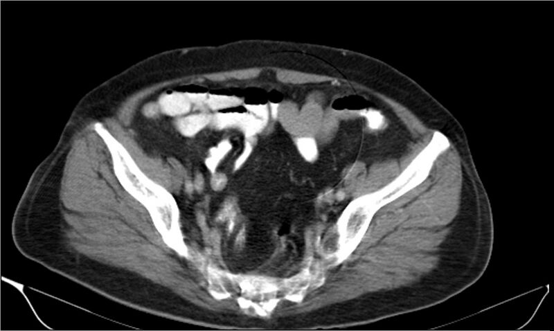 File:Necrotizing pancreatitis (Radiopaedia 20595-20495 A 37).jpg
