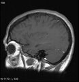 Neurosarcoidosis (Radiopaedia 10930-17204 Sagittal T1 C+ 14).jpg
