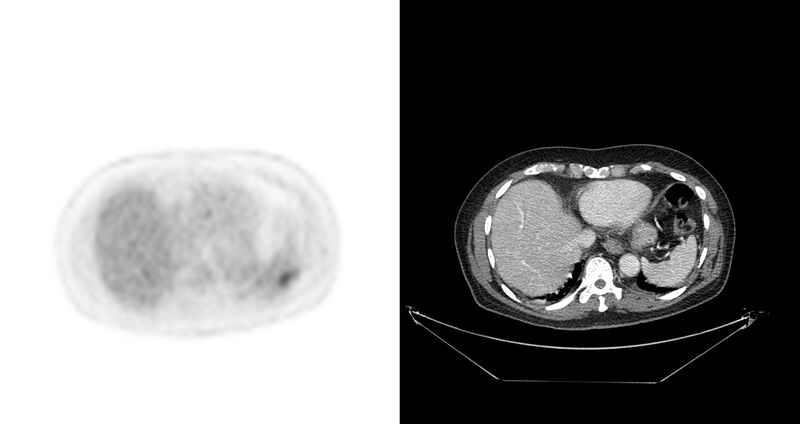 File:Non-Hodgkin lymphoma involving seminal vesicles with development of interstitial pneumonitis during Rituximab therapy (Radiopaedia 32703-33675 axial PET CT 40).jpg