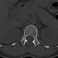 Normal CT lumbar spine (Radiopaedia 53981-60118 Axial bone window 11).jpg