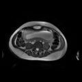 Normal MRI abdomen in pregnancy (Radiopaedia 88001-104541 Axial Gradient Echo 33).jpg