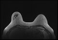 Normal breast MRI - dense breasts (Radiopaedia 80454-93850 Axial T1 50).jpg