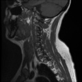 Normal cervical and thoracic spine MRI (Radiopaedia 35630-37156 Sagittal T1 2).png