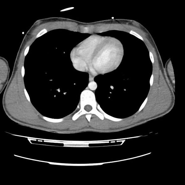File:Normal dual-phase trauma CT chest,abdomen and pelvis (Radiopaedia 48092-52899 A 37).jpg