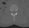 Normal lumbar spine CT (Radiopaedia 46533-50986 Axial bone window 26).png