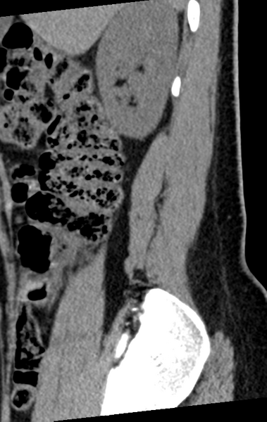 File:Normal lumbar spine CT (Radiopaedia 46533-50986 C 94).png