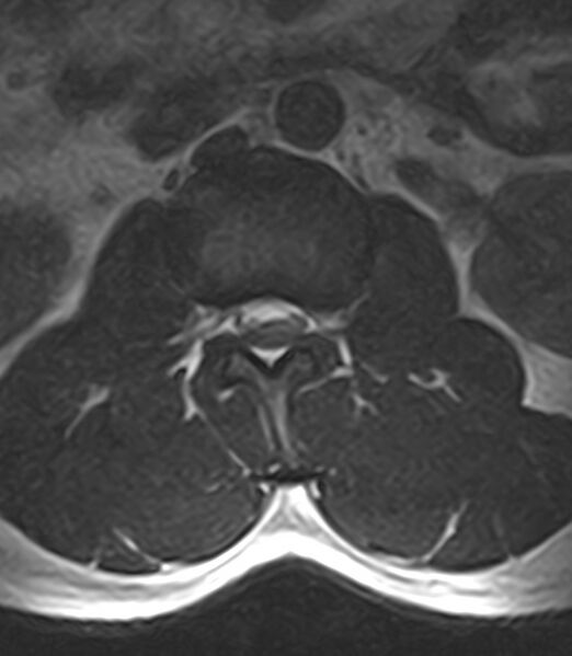 File:Normal lumbar spine MRI - low-field MRI scanner (Radiopaedia 40976-43699 Axial T2 32).jpg