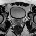 Normal prostate (MRI) (Radiopaedia 29986-30535 Axial T2 14).jpg