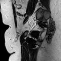 Normal prostate (MRI) (Radiopaedia 29986-30535 Sagittal T2 22).jpg