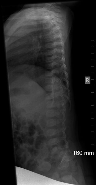 File:Normal skeletal survey - 5-month-old (Radiopaedia 53220-59186 B 1).jpg
