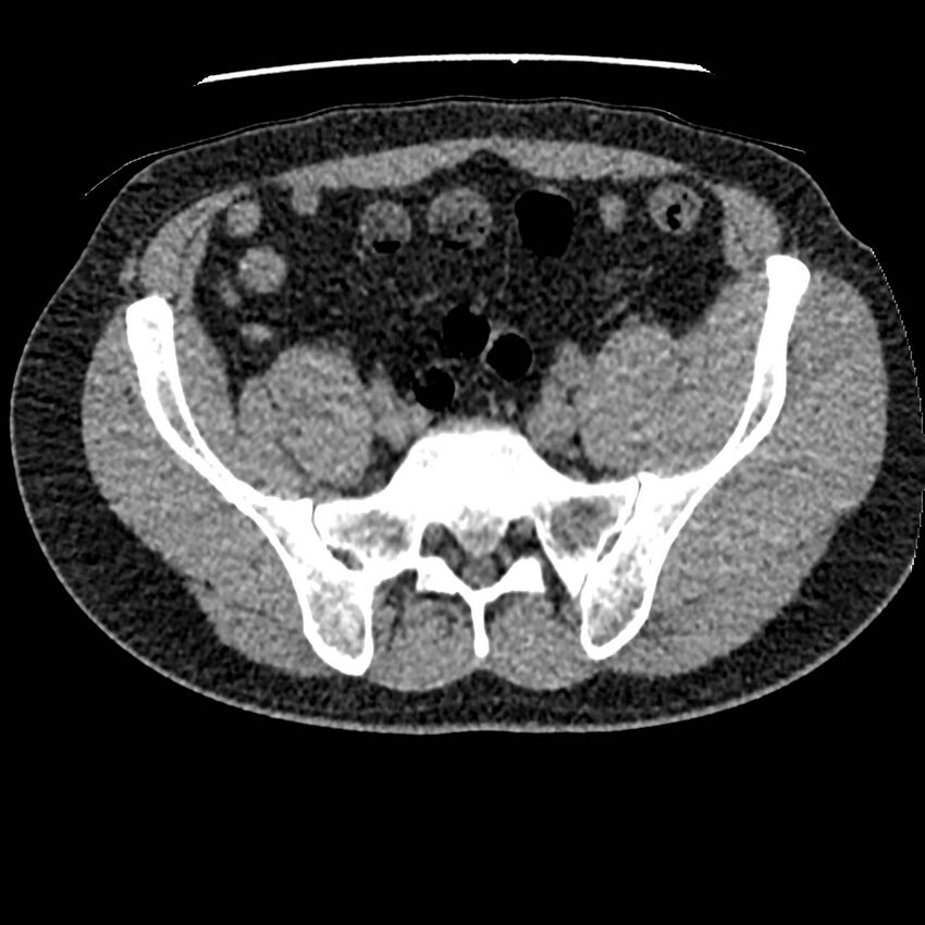 Obstructing ureteric calculus and ureteric anatomy (Radiopaedia 62730-71042 Axial non-contrast 117).jpg