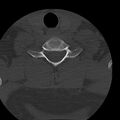 Occipital condyle fracture (Radiopaedia 31755-32691 Axial bone window 64).jpg