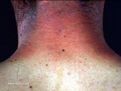 Photocontact dermatitis (sparing of covered part of body)