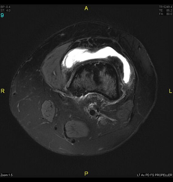 File:ACL mucoid degeration with cystic changes (Radiopaedia 48428-53341 Axial PD fat sat 6).jpg