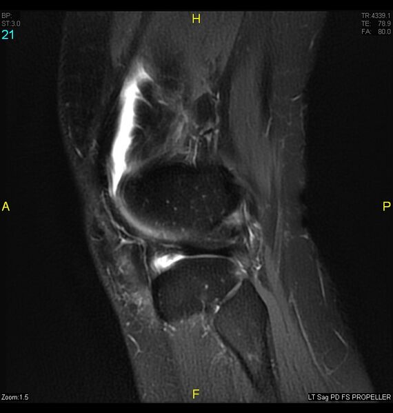 File:ACL mucoid degeration with cystic changes (Radiopaedia 48428-53341 Sagittal PD fat sat 19).jpg