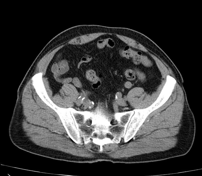 File:Abdominal aortic aneurysm (Radiopaedia 22421-22458 non-contrast 43).jpg