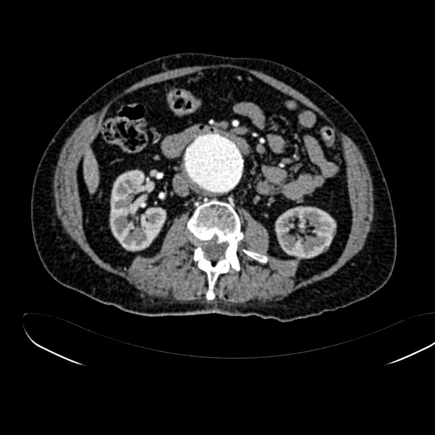 Abdominal aortic aneurysm (Radiopaedia 75131-86203 Axial C+ arterial phase 22).jpg