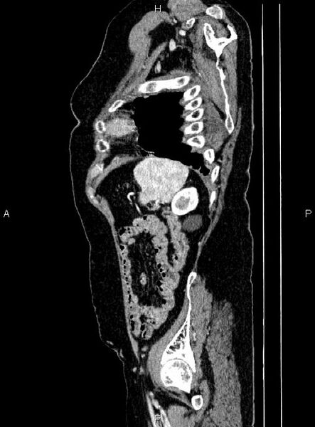 File:Abdominal aortic aneurysm (Radiopaedia 85063-100606 Sagittal C+ arterial phase 69).jpg