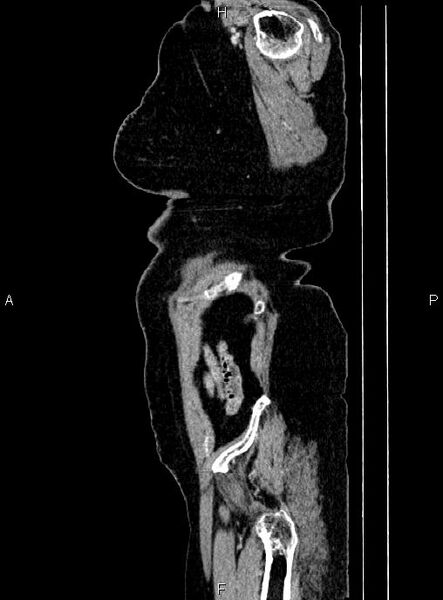 File:Abdominal aortic aneurysm (Radiopaedia 85063-100606 Sagittal C+ arterial phase 80).jpg