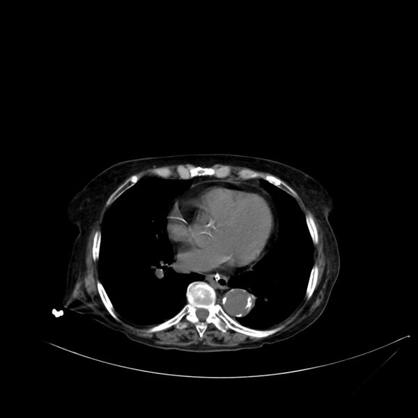 File:Abdominal aortic aneurysm - impending rupture (Radiopaedia 19233-19246 Axial non-contrast 6).jpg
