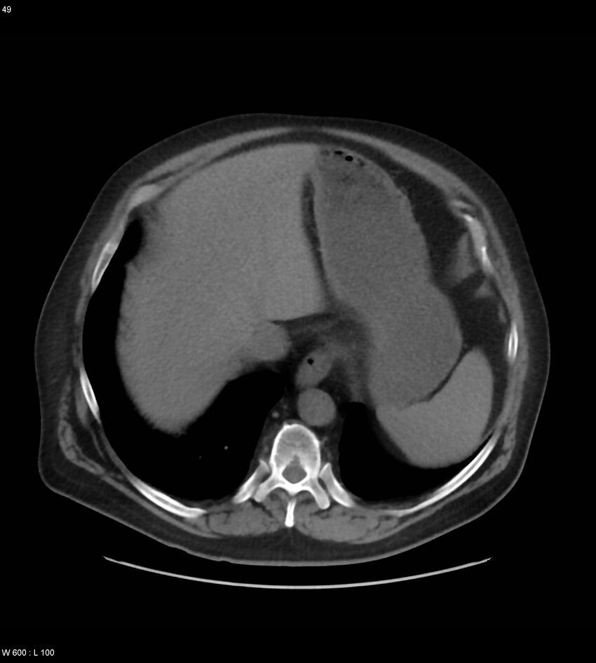 Abdominal aortic aneurysm with intramural hematoma then rupture (Radiopaedia 50278-55631 Axial non-contrast 45).jpg