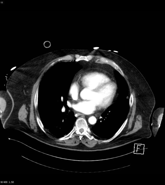 File:Abdominal aortic aneurysm with intramural hematoma then rupture (Radiopaedia 50278-55632 Axial C+ arterial phase 10).jpg