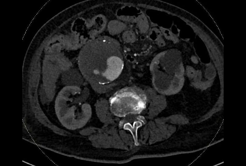 File:Abdominal aortic aneurysm with thrombus fissuration (Radiopaedia 73192-83919 Axial C+ arterial phase 99).jpg