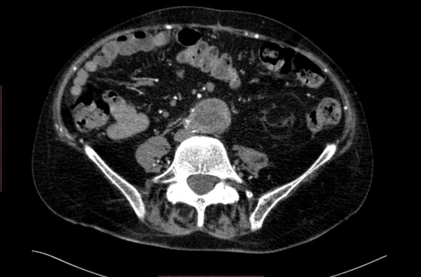 Abdominal aortic interposition tube graft and aneurysm thrombosis (Radiopaedia 71438-81857 Axial C+ arterial phase 123).jpg