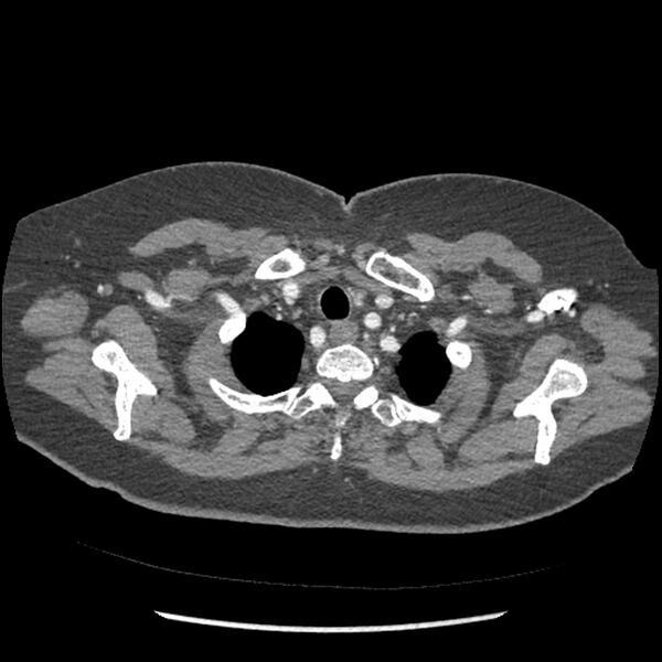 File:Aberrant right subclavian and left vertebral arteries (Radiopaedia 43467-46847 Axial C+ portal venous phase 12).jpg