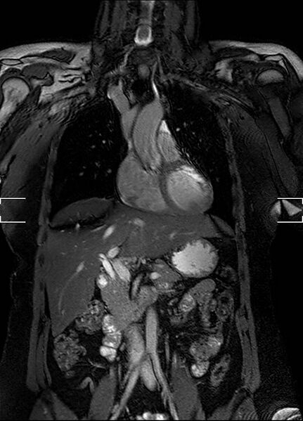 File:Aberrant right subclavian artery with background Takayasu arteritis (Radiopaedia 21423-21363 Coronal MRA 7).jpg