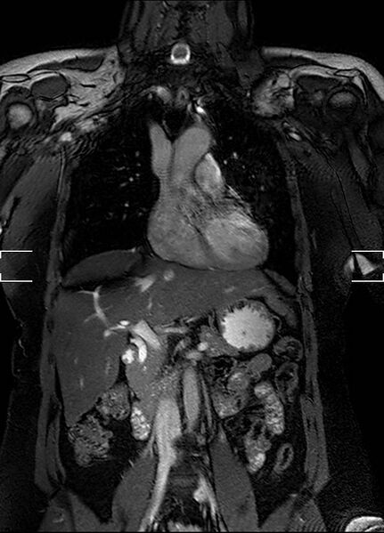 File:Aberrant right subclavian artery with background Takayasu arteritis (Radiopaedia 21423-21363 Coronal MRA 9).jpg