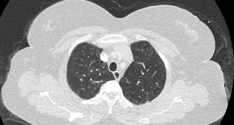 File:Accessory right inferior hepatic vein (Radiopaedia 65245-74259 Axial lung window 9).jpg