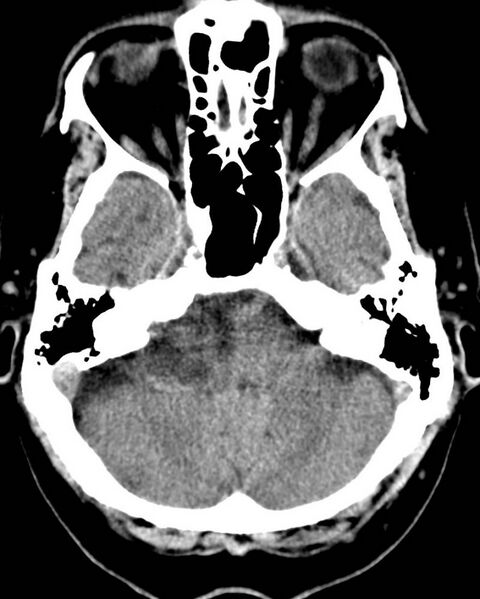 File:Acoustic schwannoma (Radiopaedia 2574-6269 Axial non-contrast 1).jpg