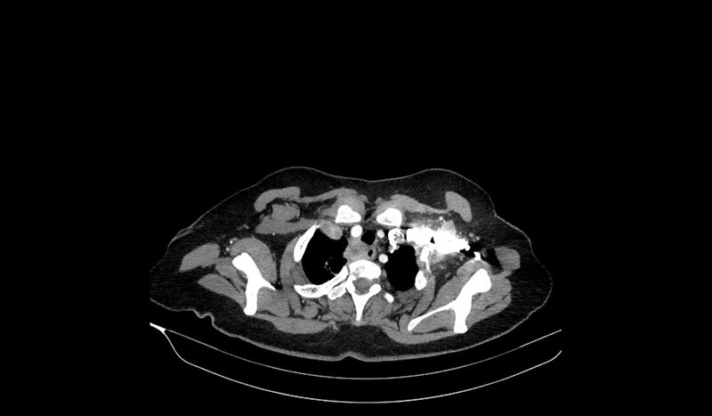 File:Acquired tracheo-esophageal fistula (Radiopaedia 51356-57103 Axial C+ arterial phase 17).jpg