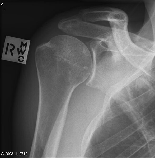 File:Acromion fracture (Radiopaedia 12284-12581 Frontal 1).jpg