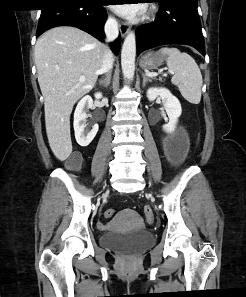File:Active Crohn disease (Radiopaedia 59394-66750 Coronal C+ portal venous phase 44).jpg