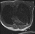 Active right ventricular cardiac sarcoidosis (Radiopaedia 55596-62100 Axial Dynamic perfusion scan MOCO 25).jpg