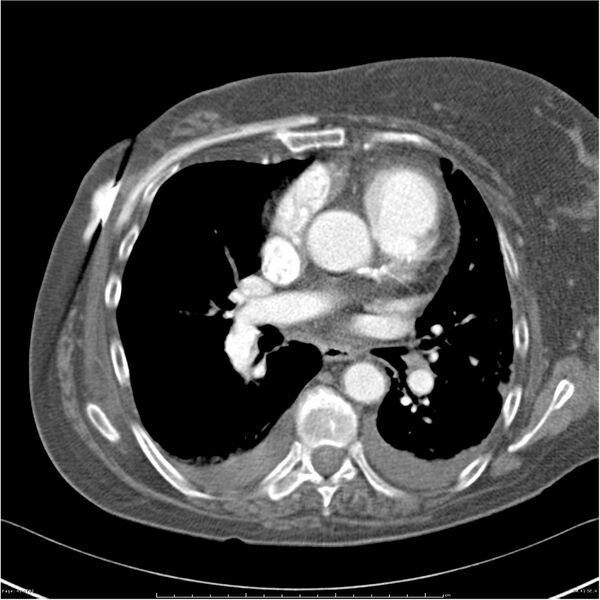 File:Acute-on-chronic pulmonary emboli (Radiopaedia 27925-28169 C+ CTPA 41).jpg