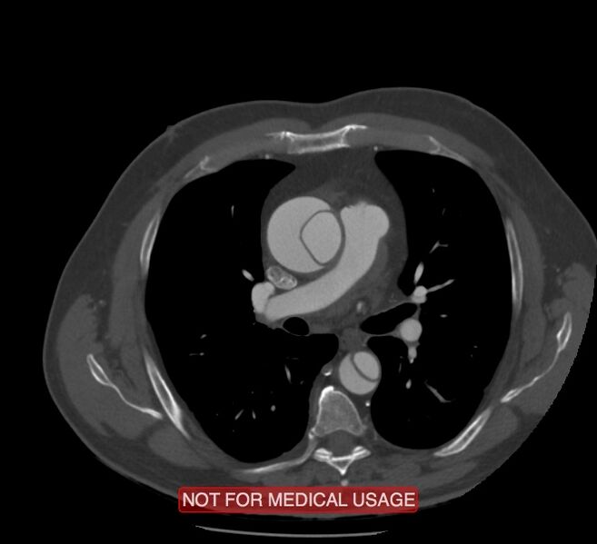 File:Acute aortic dissection - Stanford type A (Radiopaedia 40661-43285 Axial C+ arterial phase 26).jpg