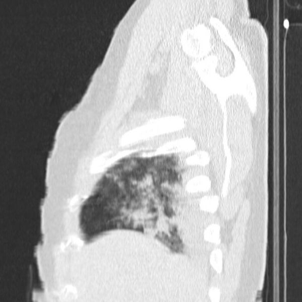 File:Acute aspiration pneumonitis (Radiopaedia 33605-34703 Sagittal lung window 14).jpg