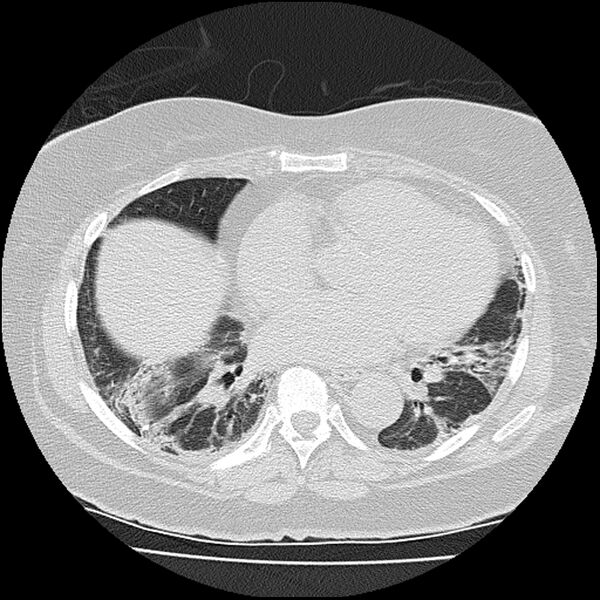 File:Acute interstitial pneumonitis (Radiopaedia 45404-49452 Axial lung window 58).jpg