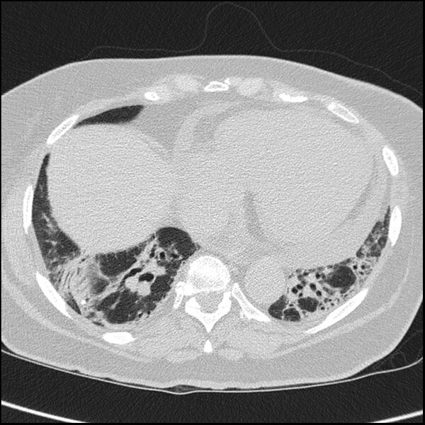 File:Acute interstitial pneumonitis (Radiopaedia 45404-49453 Axial lung window 58).jpg