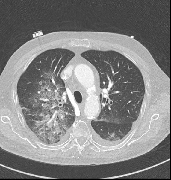 File:Acute myocardial infarction (Radiopaedia 23413-23481 lung window 10).jpg